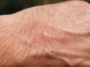 mosquito-bite-2117420_640(1)